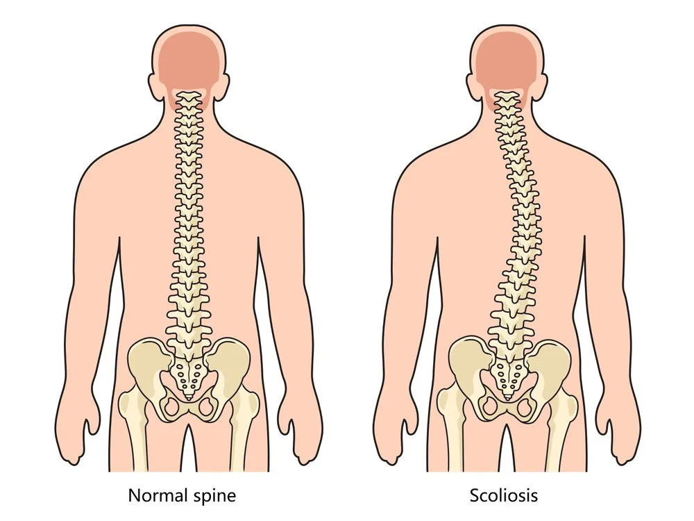 Scoliosis Diagnosis, Treatment & Chiropractic Spinal Care in Chicago