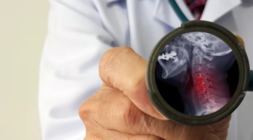 DRX Chicago Treatment Of Neck Pain – Cervical Spine Spondylosis – Degenerative Disc Disease