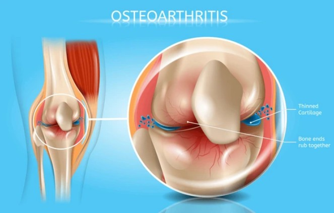 Rising Tide of Osteoarthritis