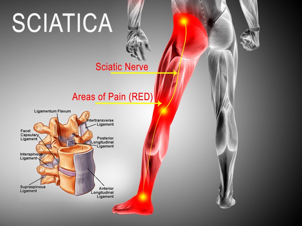 Chicago Sciatica Nerve Pain Relief at Advanced Spine in Lakeview IL